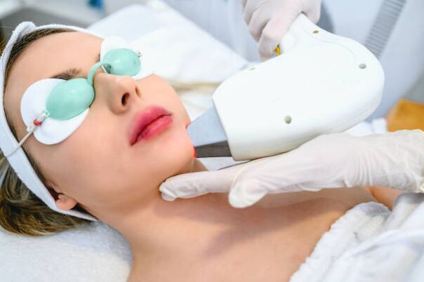 láser facial procedemento de rexuvenecemento da pel