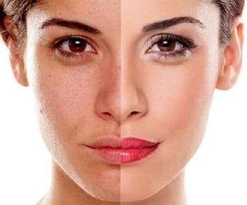 a pel facial cambia despois da peladura con láser