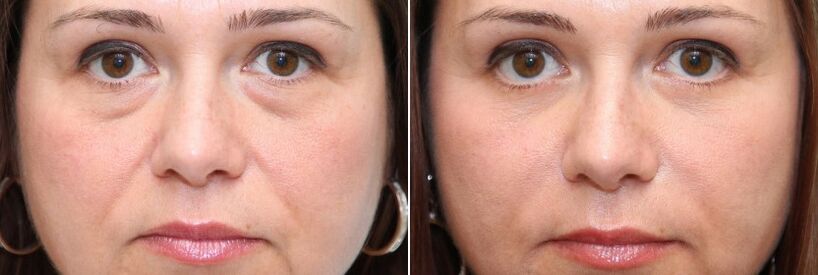 Antes e despois da blefaroplastia - eliminación do corpo graxo baixo os ollos e endurecemento da pel