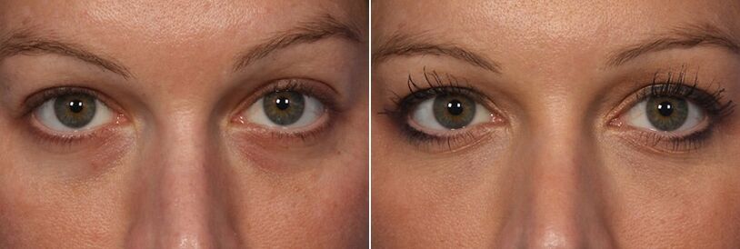 Antes e despois do uso de recheos inxectables - redución dos círculos baixo os ollos